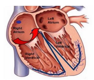 冠心病怎么治疗才能最有效呢？你了解吗？