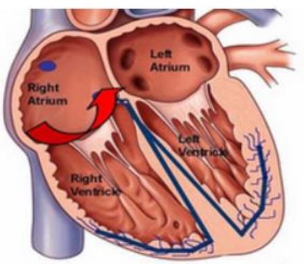 心肌缺血对身体危害大吗，这三点告诉你