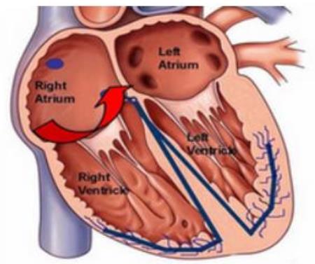心肌梗死容易复发发病人群，发病时应该怎么办