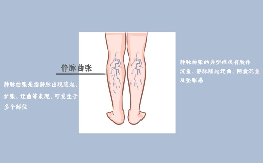 小腿静脉曲张穿弹力袜有用吗