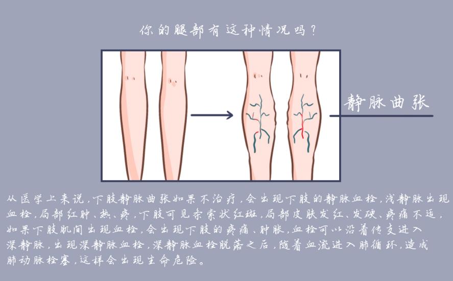 静脉曲张穿迈迪静脉曲张袜多久见效