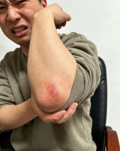 胳膊软组织损伤多久能好?